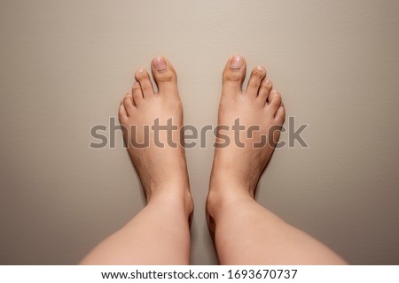 Woman feet with uneven toe. Both feet on a even colored background.Toes has small nails. Dark knuckles on the toe. Uneven toe medical condition. Royalty-Free Stock Photo #1693670737