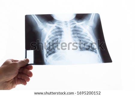 X-ray picture of the chest of a child.