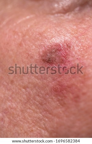 Actinic Keratosis Stock Photos And Images Avopix Com