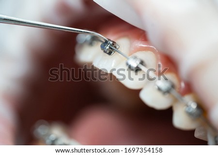 Patient's open mouth at the dentist's appointment. Braces maintenance procedure, cleaning and tightening. Orthodontics. Macro photo. Royalty-Free Stock Photo #1697354158