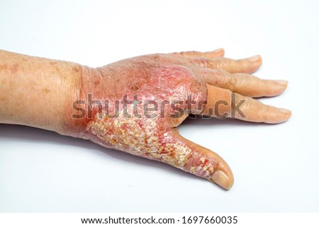 Scalds the hands on white background Royalty-Free Stock Photo #1697660035