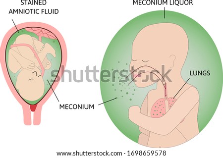 the process of Meconium aspiration syndrome, neonatal aspiration of meconium. Fetus in womb. Meconium around him. Child makes a breathe with green amniotic fluid. marked with lines and titles. Vector 