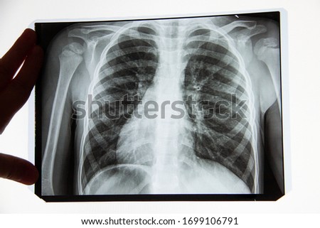 X-ray of a person s lungs with a disease. Coronavirus or cancer infected lungs. Virus screening