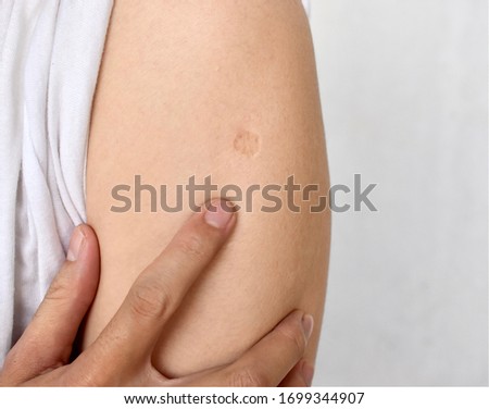 Bacillus Calmette-Guérin, BCG or TB vaccine scar mark in left arm of Asian, Burmese adult man. 2 to 6 weeks after injection, a small spot appears at site of injection. Isolated on grey background. Royalty-Free Stock Photo #1699344907