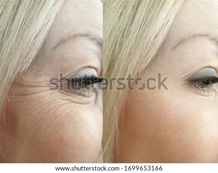 woman eyes wrinkles   after treatment Royalty-Free Stock Photo #1699653166