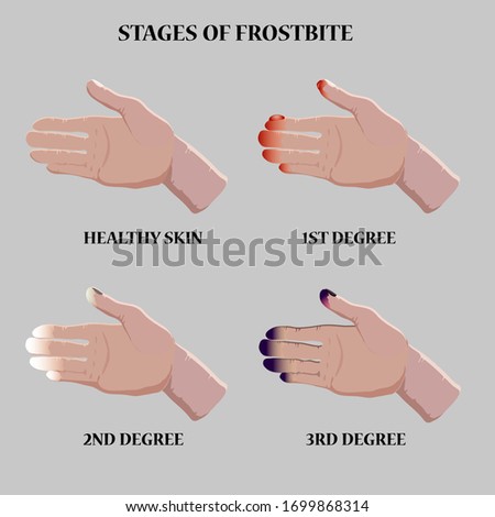 Medical vector illustration. Frostbite stages. Blue and red frostbitten fingers.  Stages of hypothermia in cold season. 