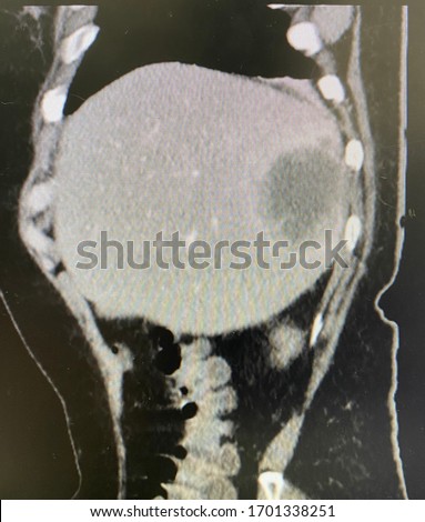 The picture of computed tomography scan with contrast of patient who have Cholangiocarcinoma at segment 6 of liver. Sagittal view.Medical Technology and Science concept.