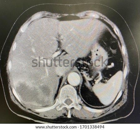 The picture of computed tomography scan with contrast of patient who have Cholangiocarcinoma at segment 6 of liver. Horizontal view.Medical Technology and Science concept.