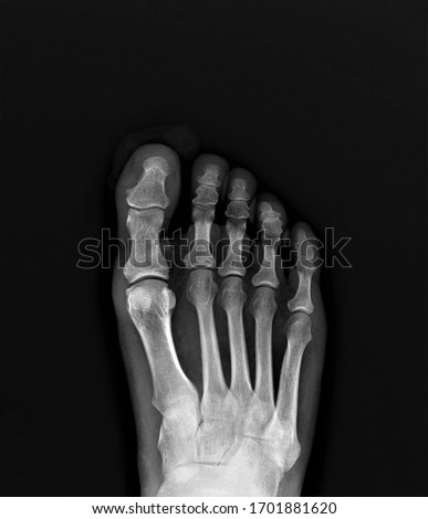 normal x-ray of the foot bones