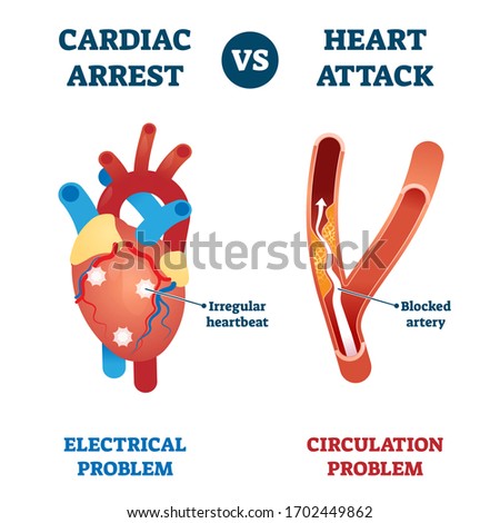 Cardiac arrest vs heart attack vector illustration. Labeled health problems comparison - electrical or circulation caused. Medical educational sick organ failure diagnosis scheme with explanation. Royalty-Free Stock Photo #1702449862
