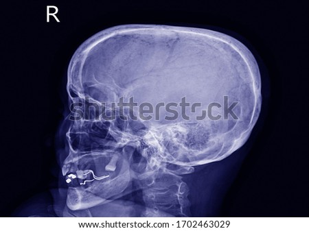 X-ray skull Finding The cranial vault is intact.No abnormal intra-cranial calcification or pneumocephalus is noted.The sella turcica looks narmal.Medical image concept.