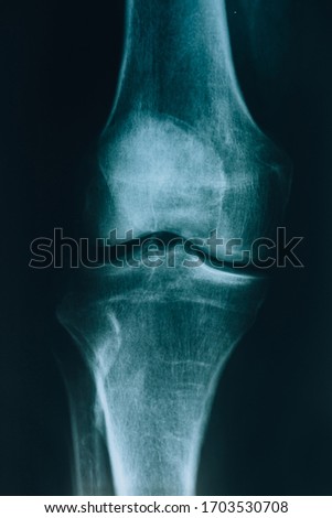 X-ray joint. A real x-ray picture of a leg joint. At the doctor’s appointment, hospital.