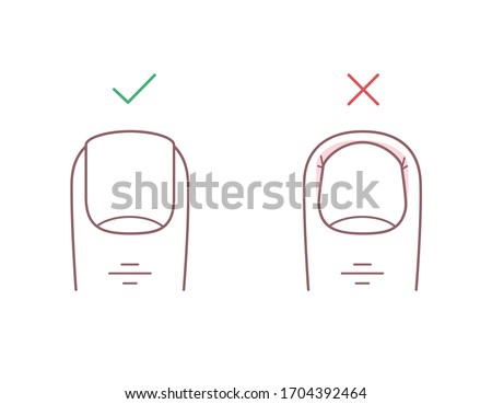 How to trim your toenails correctly. Proper and improper trimming of nails. Line illustration of cut straight and cut too deep. Pedicure, manicure, beauty spa salon Royalty-Free Stock Photo #1704392464