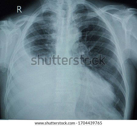X-ray chest :Upright a male 79 year old ,Finding Massive right pleural effusion,no pulmonary in filtration or congestion,Left costrophrenic angle is shap.Normal heart size and bony thorax.