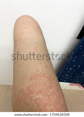 the picture of erythematous rash itch on human leg is call urticaria Medical and education concept