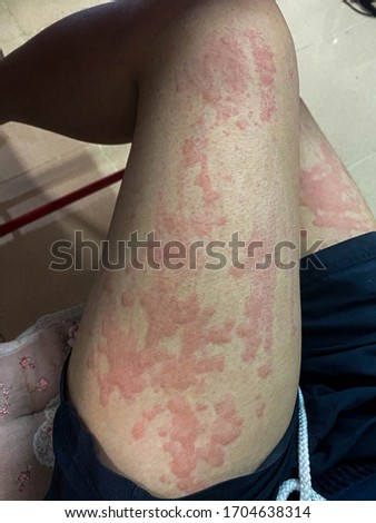 the picture of erythematous rash itch on human leg is call urticaria Medical and education concept