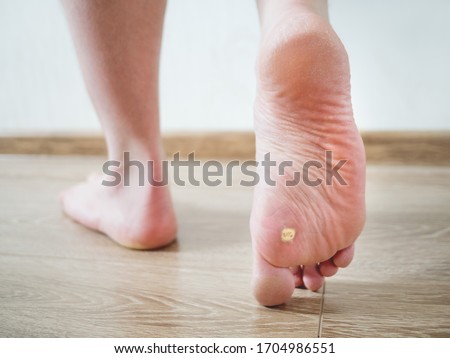 Close up photo of plantar wart on man's foot. Verruca plantaris on the heel. Royalty-Free Stock Photo #1704986551