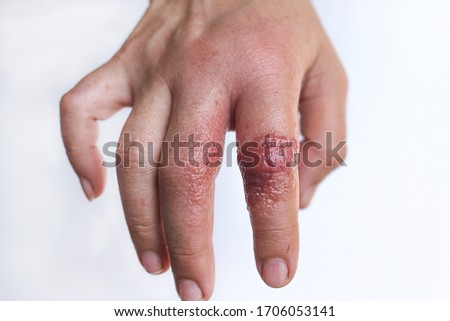 Finger hand infection with rash and blister on white background after used alcohol gel during the corona virus outbreak Royalty-Free Stock Photo #1706053141