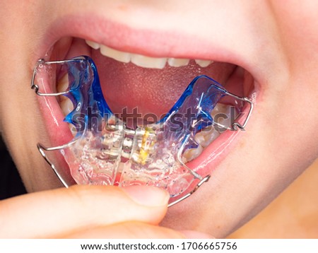 Patient photo of teeth with orthodontic braces. Wearing of braces is very popular solution for fixing congenital jaw defects Royalty-Free Stock Photo #1706665756