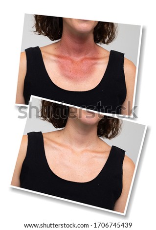 Collage comparison of healthy skin and severely sunburn skin of girl neckline. Young caucasian female neglected ultraviolet sunlight protection. Skin care concept.
