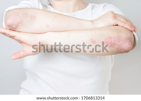 Acute psoriasis on elbows is an autoimmune incurable dermatological skin disease. Large red, inflamed, flaky rash on the knees. Joints affected by psoriatic arthritis. Royalty-Free Stock Photo #1706813314
