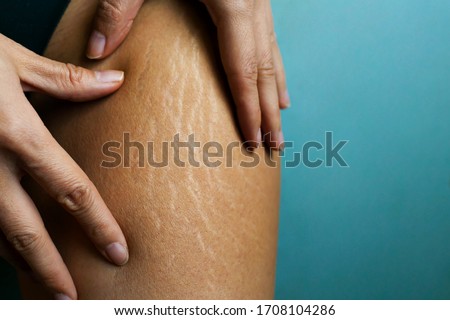 Stretch Marks On Woman's Legs. Female Hand Holds Fat Cellulite And Stretch Mark On Leg. Cellulite. Royalty-Free Stock Photo #1708104286