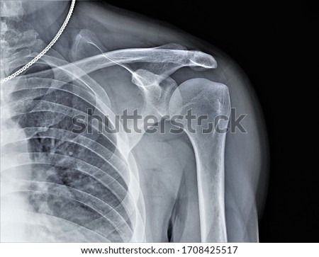 x-ray of the shoulder joint, diagnosis of bone pathology Royalty-Free Stock Photo #1708425517
