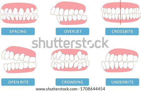 
List of dentitions that require treatment: crowding, opposite occlusion, open bite, maxillary anterior protrusion, cavities, dentition Royalty-Free Stock Photo #1708644454