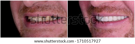full mout recovery by press ceramic crowns and implants Royalty-Free Stock Photo #1710517927