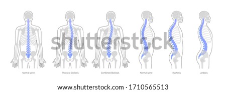 Spinal deformity flat vector illustration. Kyphosis, lordosis and scoliosis of spine infographics.. Body posture defect. Medical, educational and science banner
 Royalty-Free Stock Photo #1710565513