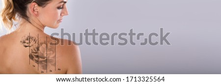 Laser Tattoo Removal From Tattooed Woman Shoulder Royalty-Free Stock Photo #1713325564