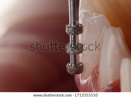 Close up intra oral view of dental ceramic veneer preparation with dental burs mark a depth cutting for ceramic space thickness. Dental photography for capture smile makeover procedure.