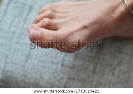 Closeup of barefeet woman with  Medical condition called bunions or hammer toes  feet problem. Royalty-Free Stock Photo #1713519421