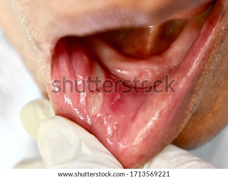 Recurrent aphthous ulcers or canker sores in inner cheek of Southeast Asian elderly man. Oval shaped ulcers in oral cavity due to sharp tooth irritation. Closeup view. Royalty-Free Stock Photo #1713569221