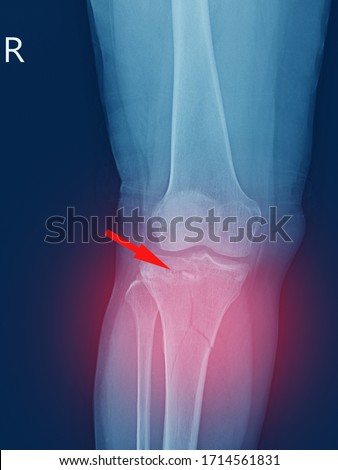 X-ray knee Fracture proximal metaphysis of tibia.Depressed fracture of lateral tibial plateau.severe swelling of soft tissue on red point .Medical healthcare concept. Royalty-Free Stock Photo #1714561831