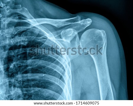 Photo of x-ray human shoulder Royalty-Free Stock Photo #1714609075