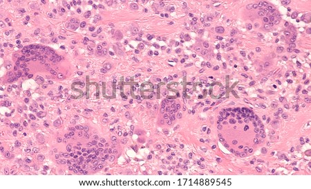 Photomicrograph of a giant cell tumor of tendon sheath, with frequent multinucleated giant cells.  Royalty-Free Stock Photo #1714889545