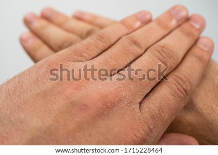 Extremely dry, dehydrated and cracked skin of a man's hand with fragments of epidermis that exfoliate due to excessive use of alcohol-based disinfectants during coronavirus (Covid-19) pandemic.  Royalty-Free Stock Photo #1715228464