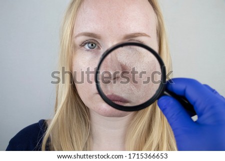 Oily and problem skin. Portrait of a blonde girl with acne, oily skin and pigmentation Royalty-Free Stock Photo #1715366653
