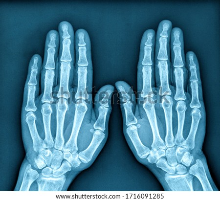 Photo of X ray Image of both human hands