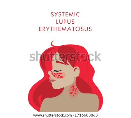 SLE, red systemic lupus erythematosus, red butterfly on the face skin rashes, acne. girl with a butterfly on her face. vector stock illustration white background, in cartoon style, place for text