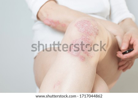 Acute psoriasis on the knees ,body ,elbows is an autoimmune incurable dermatological skin disease. Large red, inflamed, flaky rash on the knees. Joints affected by psoriatic arthritis. Royalty-Free Stock Photo #1717044862