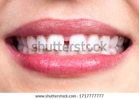 Diastema between tooth. Spacing between front teeth Royalty-Free Stock Photo #1717777777