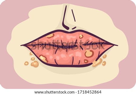 Illustration of Lips with Cold Sores Symptom of Infection