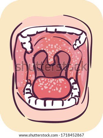 Illustration of Wide Opened Mouth with Oral Thrush Symptom of HIV