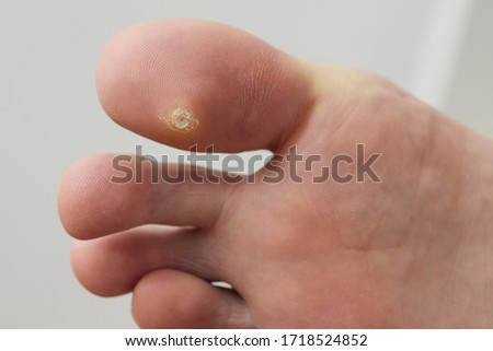 Medical detail shot of a toe wart. Royalty-Free Stock Photo #1718524852