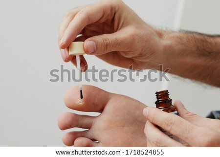 Man applying liquid on the wart of his foot. Home treatment of a veruca toe. Royalty-Free Stock Photo #1718524855