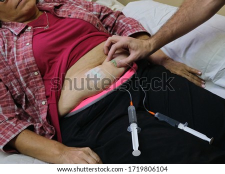 a physician putting a subcutaneous vial for the treatment of a Chronic Inflammatory Demyelinating Polyneuropathy in a woman with covid-19 during the pandemic
