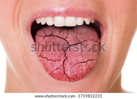 Woman Mouth And Broken Tongue With Cracks Royalty-Free Stock Photo #1719832231