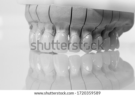 Dental zircon ceramic crowns on model